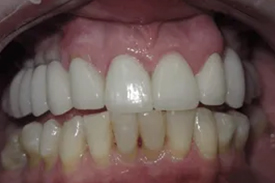 Restoring Implants